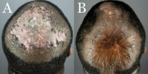 Frame A represents Folliculitis Decalvans covering the entire vertex before excision. Frame B is the same patient eight months after operation and second-intention healing. The doctor used high-tension sutures and skin grafts for the above patient.