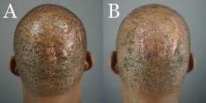 Frame A represents Folliculitis Decalvans on the right parietal prominence area before surgical excision. Frame B is the same patient 9 months after lesion excision and second-intention healing with high-tension sutures.