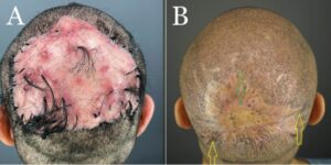 Preoperative FD plaque involving the vertex, mid-scalp extending to the frontal scalp, and acne keloidalis nuchae in the nape area (A) and nineteen months after complete excision of FD lesion and healing by second intention, aided by guarded high-tension sutures and a minor STSG (Green arrow). The tenting skin has flattened out (yellow arrows (B).