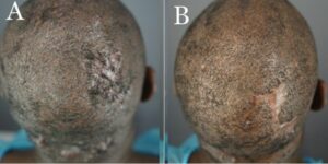 FD plaque involving the right parietal prominence area before surgical excision and AKN lesions in the nape zone. (A) and four months after complete excision of the FD lesion and healing by second intention, aided by guarded high-tension sutures and a minor skin graft (B).