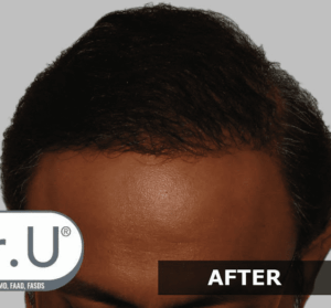 dru2-after