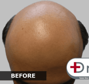 dru2-before
