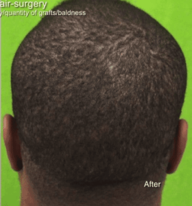 dru4-after