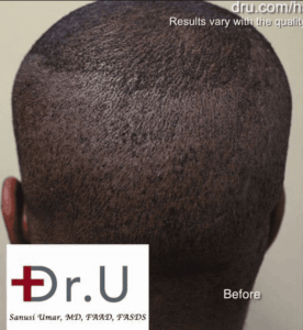 dru4-before