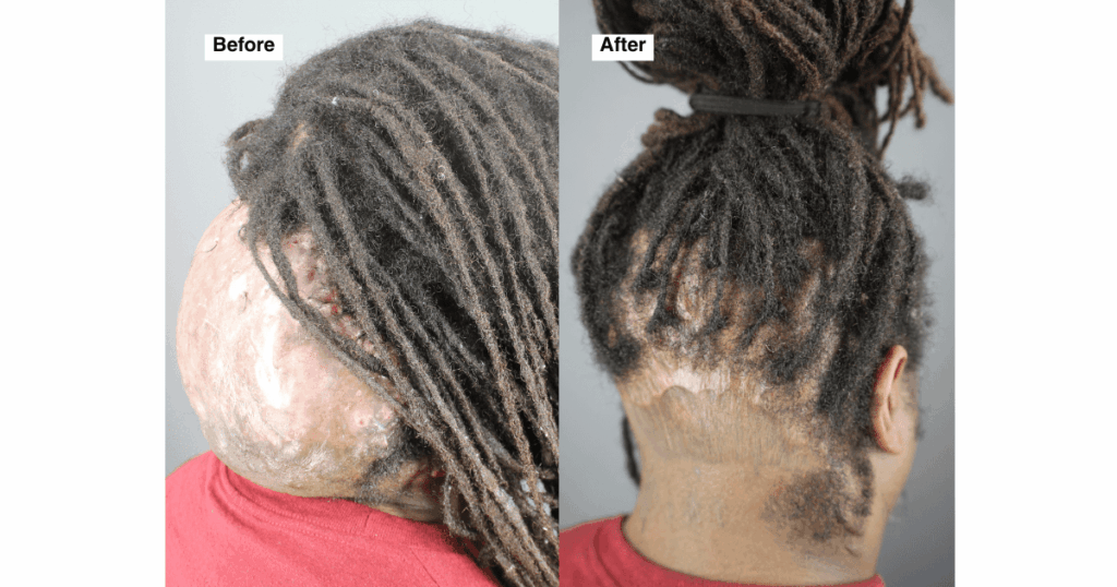 Side-by-side image showing the back of Fred’s head before surgery with a large Acne Keloidalis Nuchae (AKN) lesion, and after surgery with a smooth, healed scalp and no visible mass, allowing him to return to everyday activities.