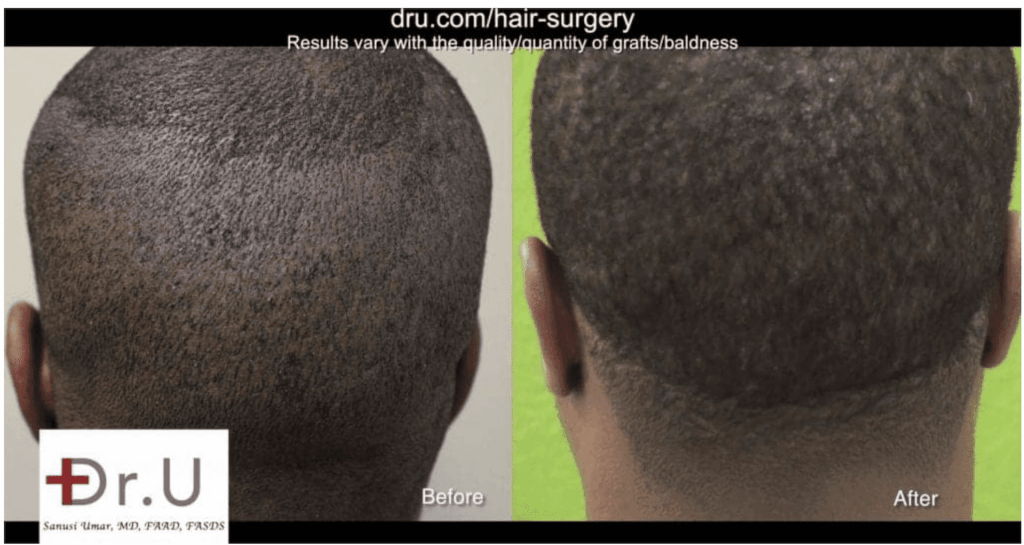 Back view comparison of African descent patient before and after FUE hair transplant with Dr. UGraft Zeus showing increased hair density and natural growth.