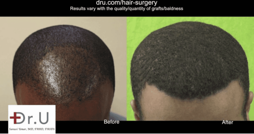 Comparison of an African descent patient before and after FUE hair transplant with Dr. UGraft Zeus showing restored hairline and fuller hair coverage.