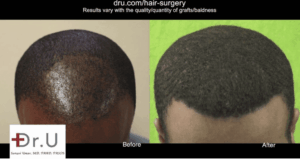 Comparison of an African descent patient before and after FUE hair transplant with Dr. UGraft Zeus showing restored hairline and fuller hair coverage.