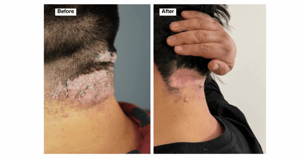 Side view of Jorge’s neck showing Acne Keloidalis Nuchae before treatment with inflamed, raised bumps and scaly patches; after surgery, the skin appears flat, pink, and healed with minimal scarring.