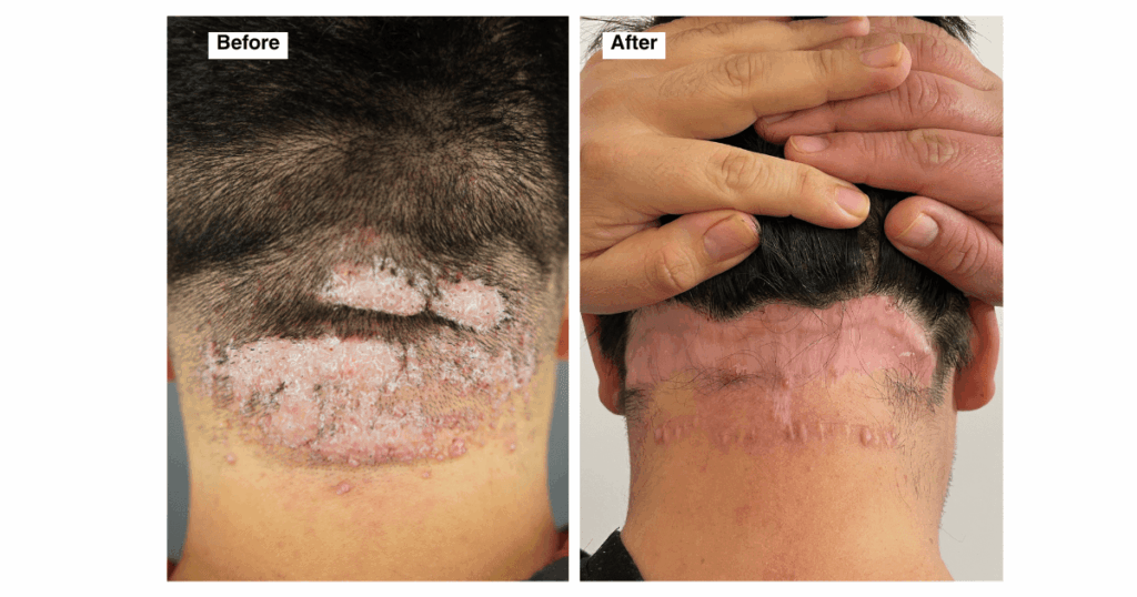 Back view of Jorge’s neck showing a large, inflamed Acne Keloidalis Nuchae lesion before surgery; after treatment, the lesion is gone, replaced with flat, pink scar tissue and no signs of active inflammation.