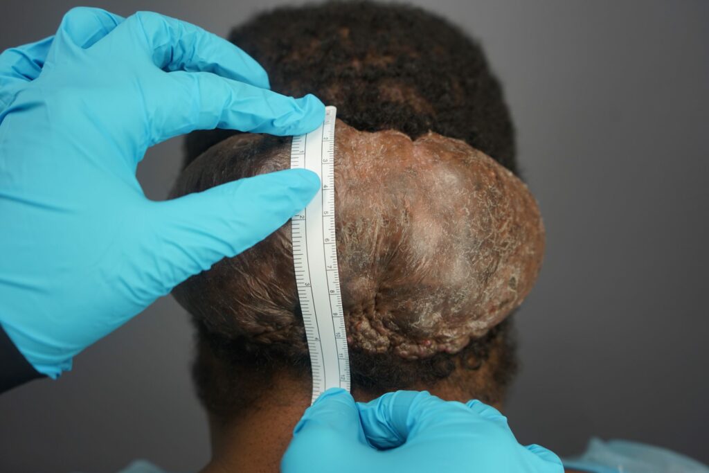 Measurement of Adrian’s large Acne Keloidalis Nuchae (AKN) located behind his head.