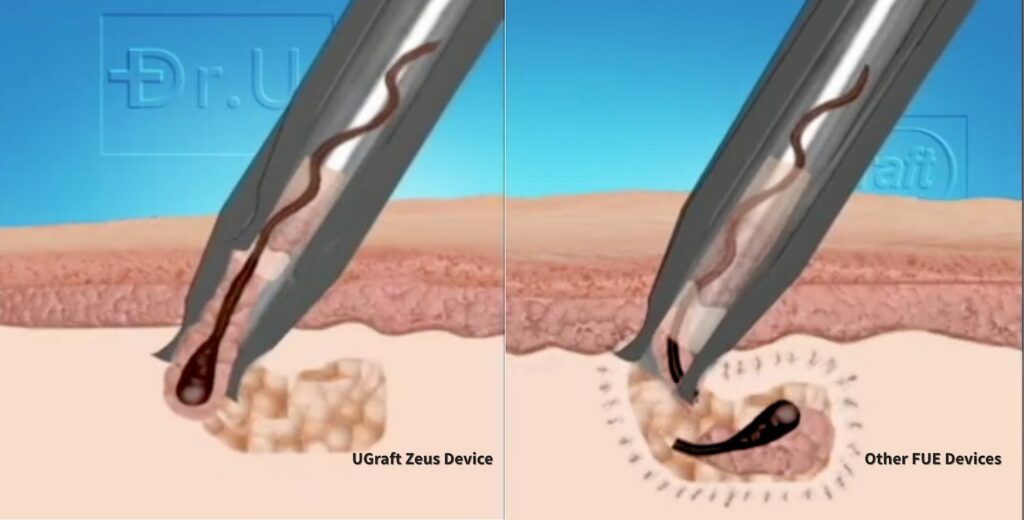 Illustration comparing UGraft Zeus device successfully extracting a curved Afro hair follicle with a standard FUE tool that transects and damages the follicle.
