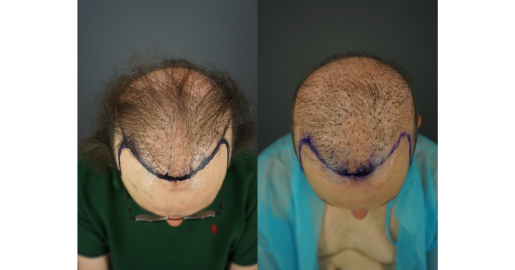 Before photos comparing Jon’s shaved and unshaved states. Despite undergoing several failed hair transplants, he still shows extensive baldness. Pluggy grafts are visible and unevenly distributed, highlighting the unnatural appearance created by previous procedures.