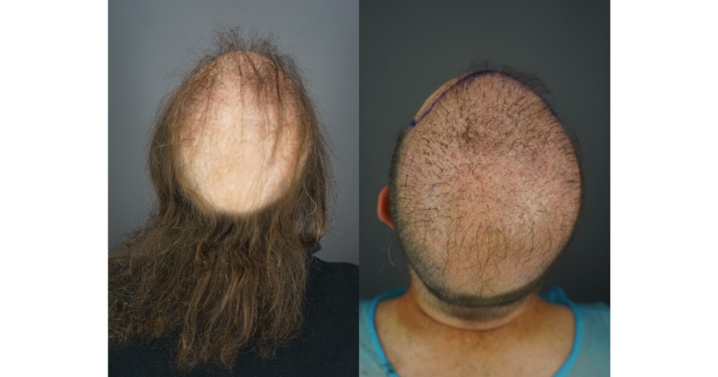 Shaving Jon’s head reveals an unnatural pattern with poorly placed grafts that failed to achieve adequate coverage.