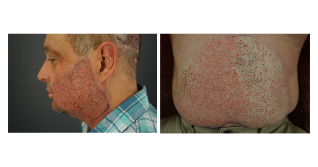 Close-up view of the abdomen and side facial profile showing tiny extraction sites after body hair graft harvesting for a hair transplant procedure.