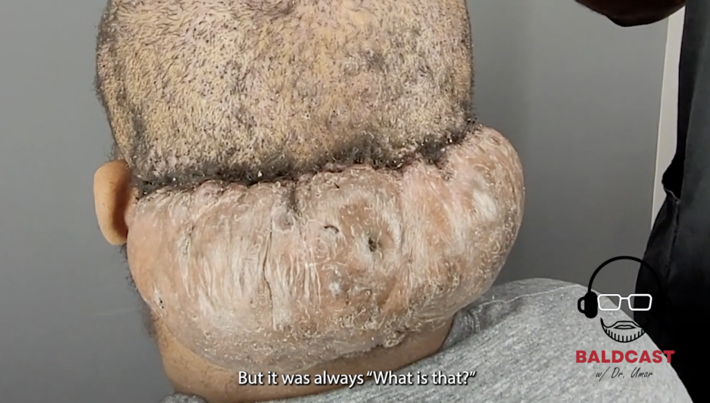 The large AKN mass on the back of Adrian’s scalp caused him to isolate himself from others. His inner voice told him he wasn’t worth anything in life.
