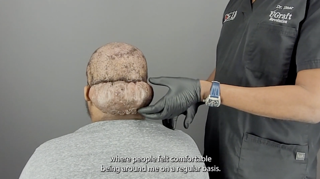 Dr. Sanusi Umar examines the large Acne Keloidalis Nuchae (AKN) mass on the back of Adrian’s head. It has negatively affected Adrian’s confidence and self-worth for eight years.

