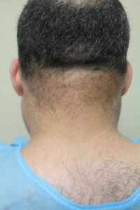 Patient with Thinning in NW 5-6 area with retrograde alopecia before head shaving 