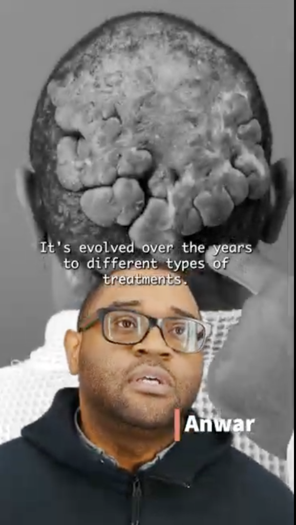 Anwar shares how he had undergone numerous treatments before, but they never seemed to help with his Folliculitis Decalvans. His scalp condition grew worse with every treatment he tried.
