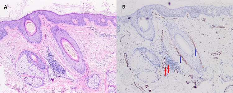 Histologic sections demonstrating perifollicular infundibulo-isthmic lymphocytic infiltrates and early fibrosis (PIILIF) in a normal-appearing scalp with androgenetic alopecia.
