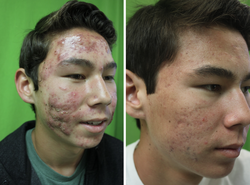 Michael’s skin went from severe breakouts to clearer and smoother with Dr. Umar’s laser treatments.