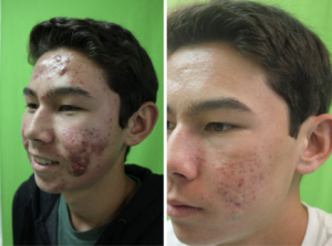 Michael’s skin went from severe breakouts to clearer and smoother with Dr. Umar’s laser treatments.