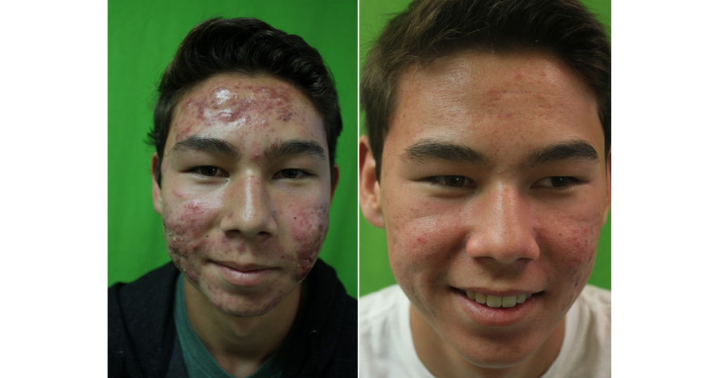 Michael’s skin and confidence both improved thanks to Dr. Umar’s laser acne treatments.