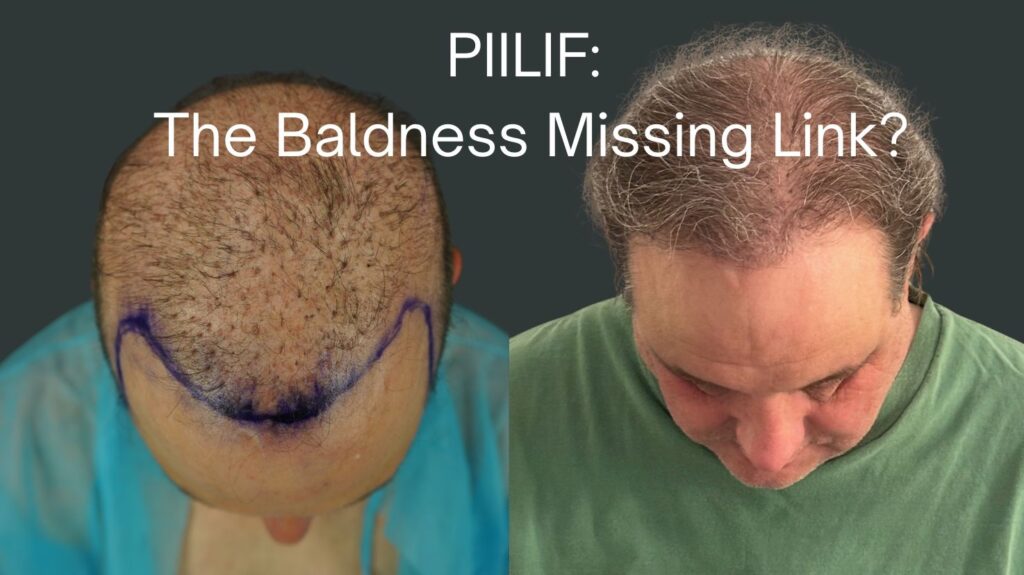 Top-down before-and-after images of a Norwood 7 androgenetic alopecia patient showing minimal growth before treatment and increased coverage after hair transplantation performed in conjunction with PIILIF-directed treatment.