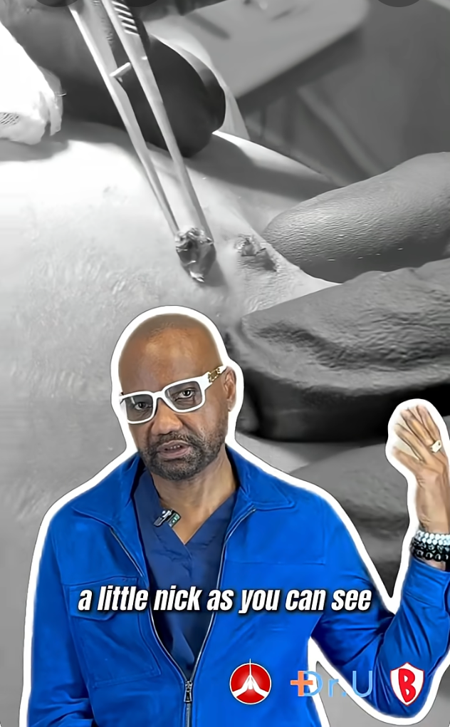 Surgical removal of blackheads allows the practitioner to remove the open comedone wall and prevent recurrence.