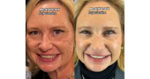 Before and after Karen’s skin rejuvenation. Dr. Sanusi Umar came up with a custom treatment plan to address Karen’s wrinkles, sun spots, and discoloration.
