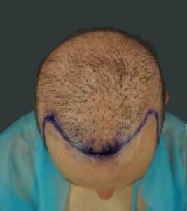 Top-down before-treatment image of Norwood 7 pattern hair loss with a prior strip-surgery scar, illustrating a complex androgenetic alopecia case discussed in relation to PIILIF.
