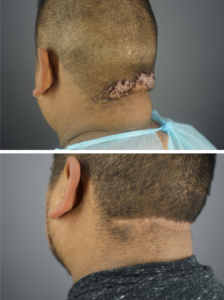 Side view of Rodolfo’s scalp showing dramatic improvement after AKN removal and second intention healing with Dr. Umar.