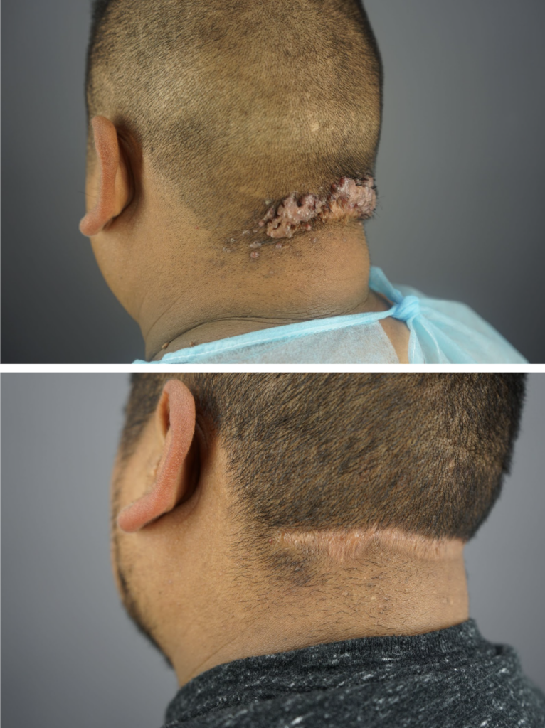Side view of Rodolfo’s scalp showing dramatic improvement after AKN removal and second intention healing with Dr. Umar.