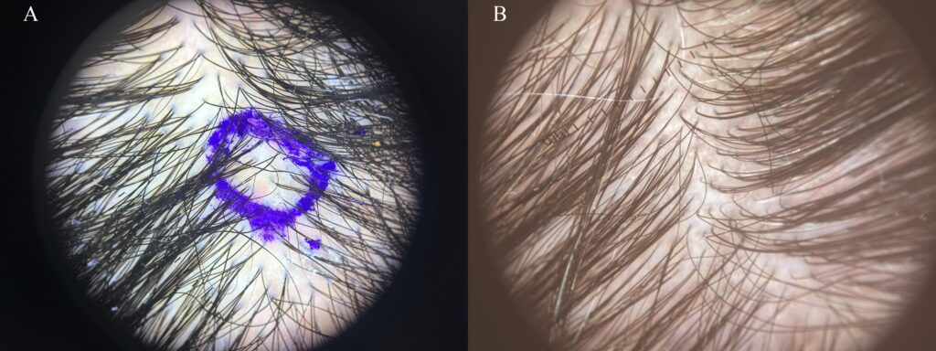 Histologic images illustrating perifollicular inflammatory changes in PIILIF identified at trichoscopy-guided biopsy sites, with findings that can mimic seborrheic dermatitis or dandruff.
