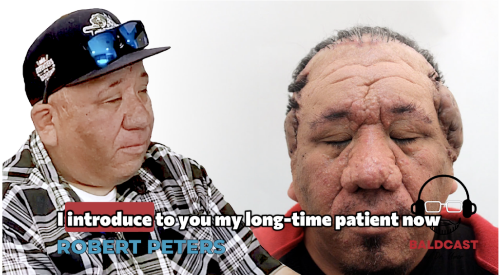 Dr. Sanusi Umar introduces one of his long-time patients and now a friend, Robert, who has a severe case of acne keloidalis nuchae