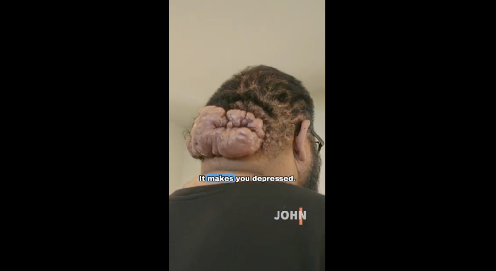 The severe, boil-like growths on John Picone's head, diagnosed by Dr. Sanusi Umar as a combination of three challenging scalp conditions.