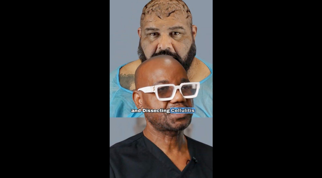 Dr. Sanusi Umar explains the intertwined condition of John’s scalp in order to provide appropriate treatment methods for long-term healing.
