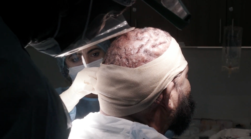 A close-up look of John's head after the successful surgery to remove his acne keloidalis nuchae bumps.
