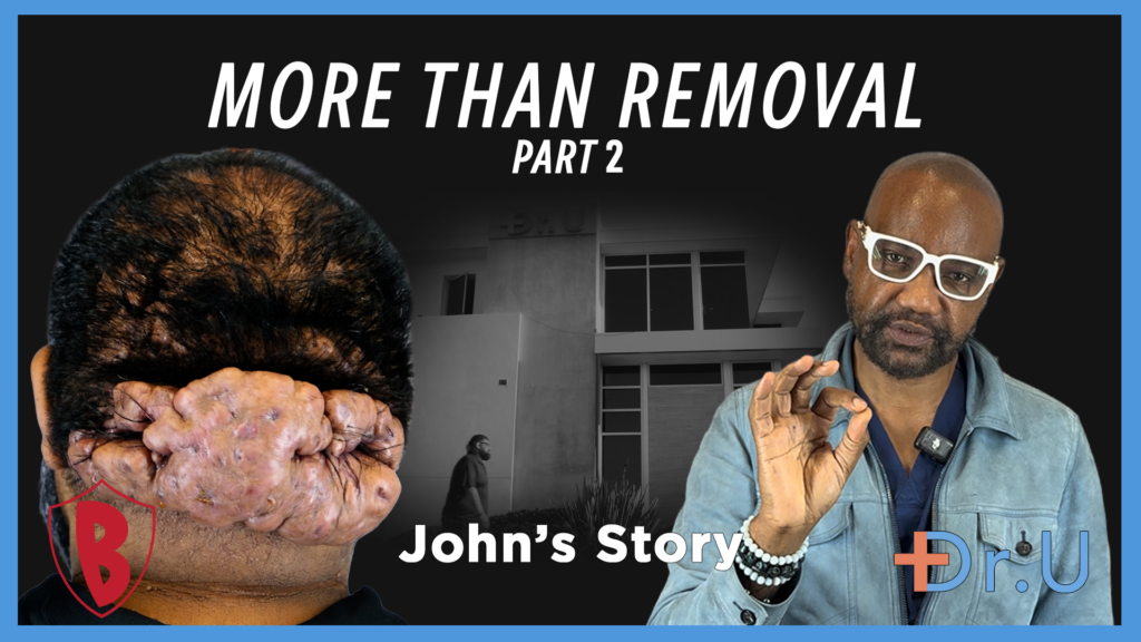 More Than the Removal of Posterior Scalp Scarring Disorder (Part 2)