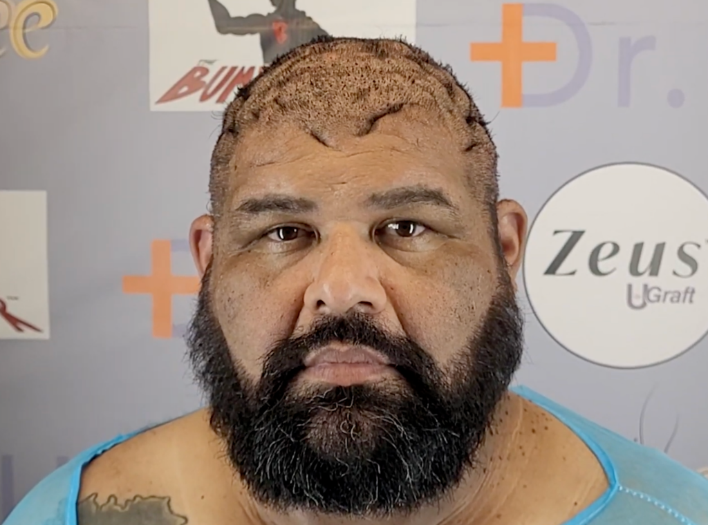 John came into the Bumpinator clinic with three current scalp conditions.

