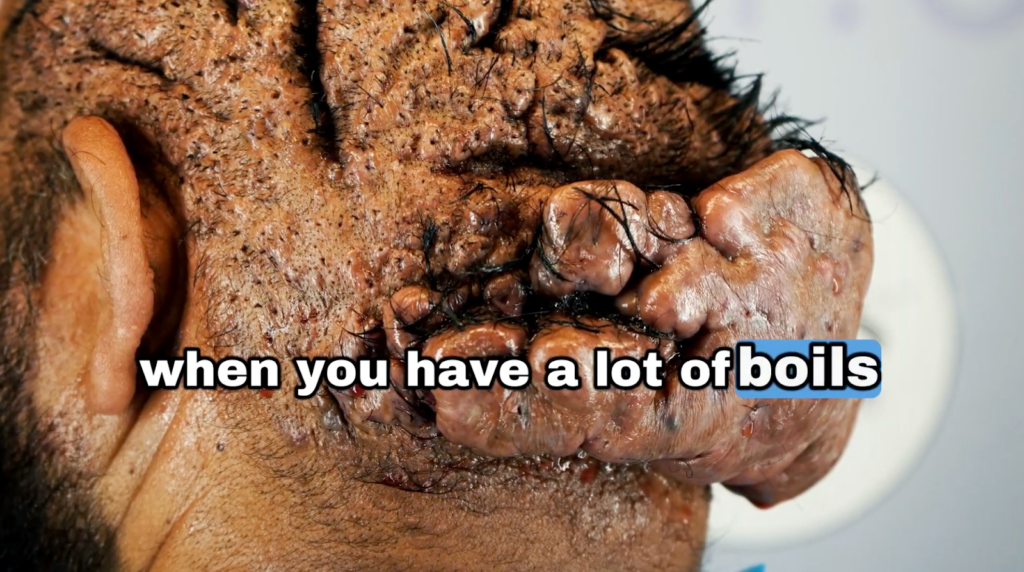 A close-up look on John’s back of the head with deep cysts and boils on the scalp.
