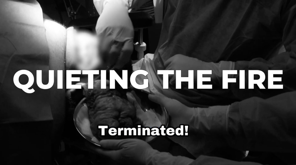 Dr. Sanusi Umar completes the removal of a diseased scalp bump during treatment for pus bumps on the scalp.
