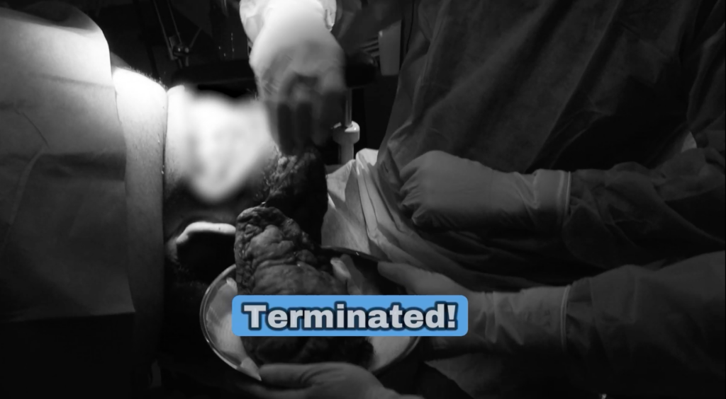 Dr. Sanusi Umar removing a large AKN scalp lesion during John’s surgical treatment.