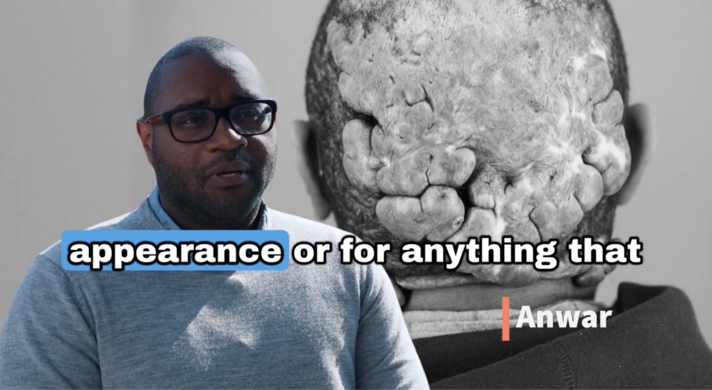 Anwar explaining how after AKN treatment people no longer stare at his scalp or treat him differently.