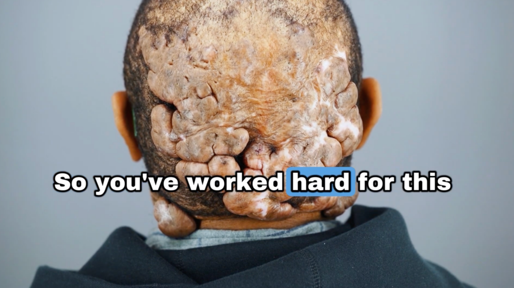 Anwar before treatment with a large AKN scalp lesion visible on the back of his head.