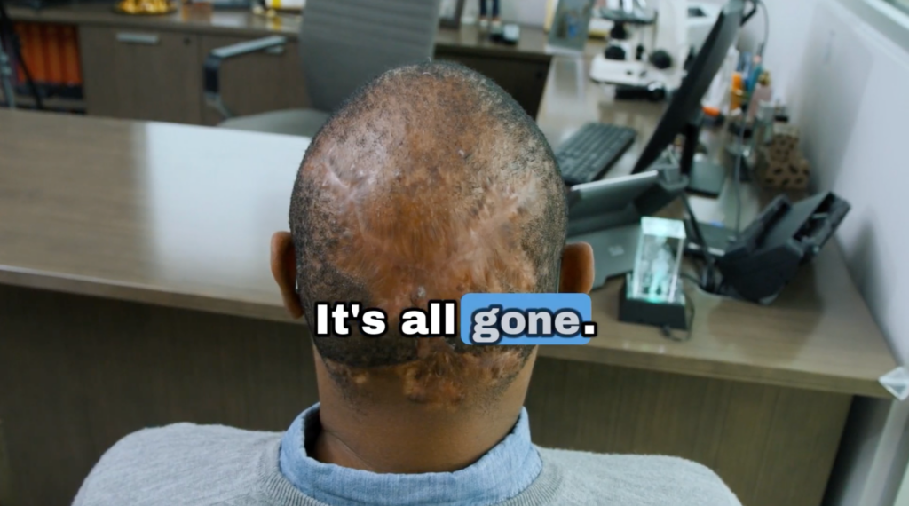 Anwar revealing his healed scalp after AKN treatment as Dr. Sanusi Umar confirms the condition is resolved.