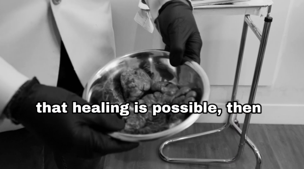 Anwar encourages others that healing from long term scalp conditions like folliculitis keloidalis nuchae is still possible.
