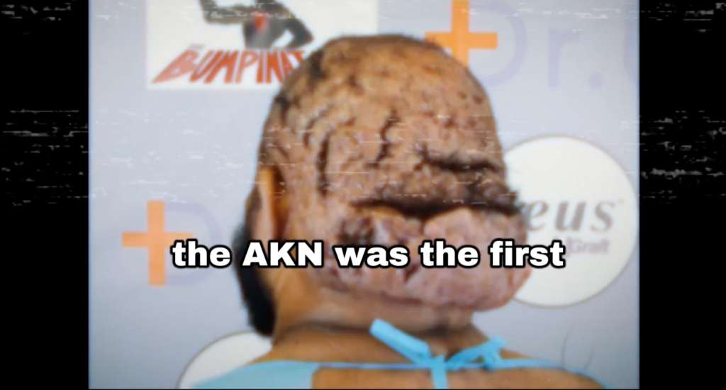 Chronic folliculitis of the nape or AKN appearing on the back of John’s scalp before other scalp conditions developed.