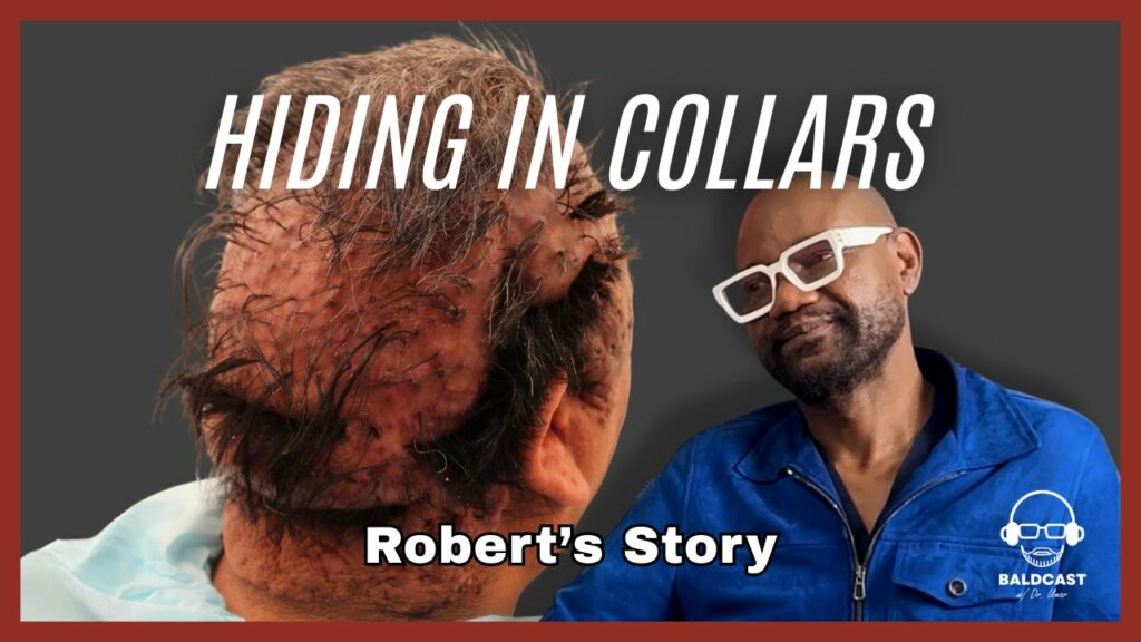 Severe Folliculitis Keloidalis Nuchae and CVG: Robert’s Life Before and After Treatment
