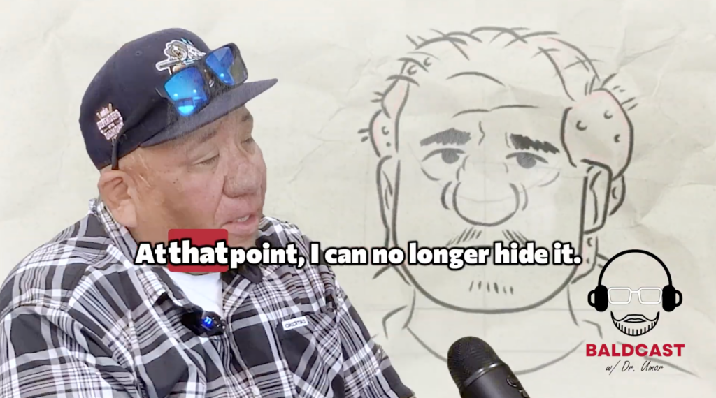 Robert explains how AKN bumps spread across his scalp and became impossible to hide.